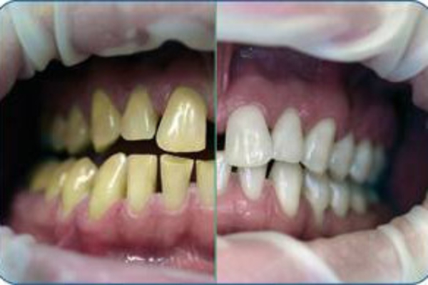 جدیدترین تکنولوژی سفید کننده دندان با قیمتی به صرفه‼️به تعداد محدود